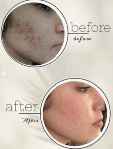 نمونه درمان جای لک و جوش دکتر زهره حاج حیدری (کلینیک زیبایی صدف)