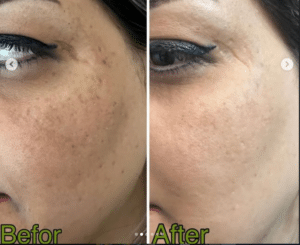 نمونه درمان جای لک و جوش دکتر زهره حاج حیدری (کلینیک زیبایی صدف)