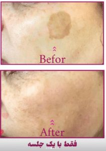 نمونه درمان جای لک و جوش دکتر زهره حاج حیدری (کلینیک زیبایی صدف)