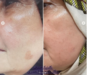 نمونه درمان جای لک و جوش دکتر زهره حاج حیدری (کلینیک زیبایی صدف)