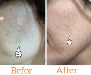 نمونه درمان جای لک و جوش دکتر زهره حاج حیدری (کلینیک زیبایی صدف)