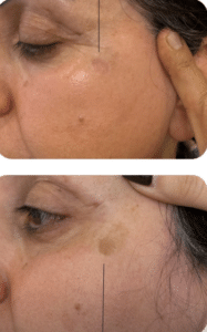 درمان جای لک و جوش دکتر آرزو عوض پور