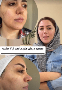 درمان جای لک و جوش دکتر آرزو عوض پور