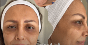 درمان جای لک و جوش دکتر آرزو عوض پور