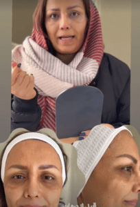 درمان جای لک و جوش دکتر آرزو عوض پور