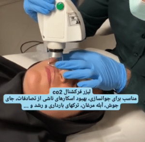 نمونه درمان جای لک و جوش دکتر صادق هاشمی نسب