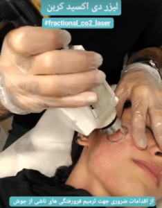 نمونه درمان جای لک و جوش دکتر صادق هاشمی نسب