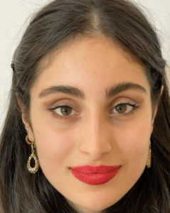 نمونه درمان جای لک و جوش دکتر گالیا رنجبر