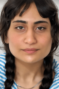 نمونه درمان جای لک و جوش دکتر گالیا رنجبر