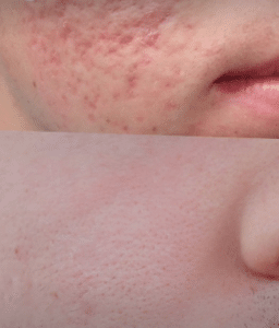 نمونه درمان جای لک و جوش دکتر قاسم رحمت پور رکنی (کلینیک زیبایی باران)