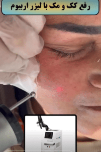 نمونه درمان جای لک و جوش دکتر قاسم رحمت پور رکنی (کلینیک زیبایی باران)