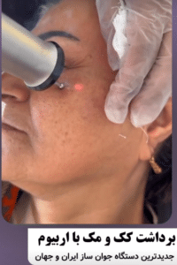 نمونه درمان جای لک و جوش دکتر قاسم رحمت پور رکنی (کلینیک زیبایی باران)