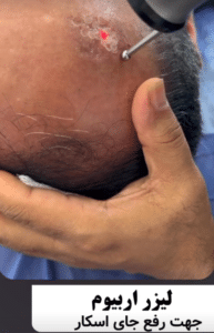 نمونه درمان جای لک و جوش دکتر قاسم رحمت پور رکنی (کلینیک زیبایی باران)