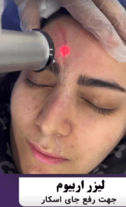 نمونه درمان جای لک و جوش دکتر قاسم رحمت پور رکنی (کلینیک زیبایی باران)