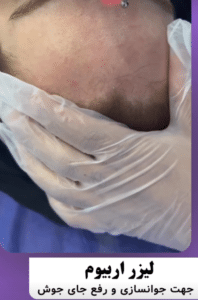 نمونه درمان جای لک و جوش دکتر قاسم رحمت پور رکنی (کلینیک زیبایی باران)