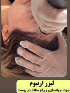 نمونه درمان جای لک و جوش دکتر قاسم رحمت پور رکنی (کلینیک زیبایی باران)