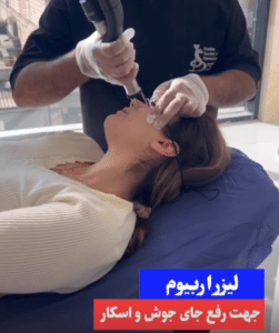 نمونه درمان جای لک و جوش دکتر قاسم رحمت پور رکنی (کلینیک زیبایی باران)