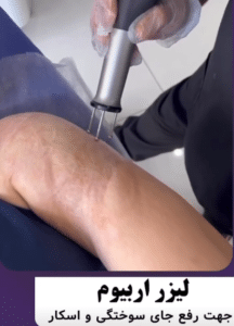 نمونه درمان جای لک و جوش دکتر قاسم رحمت پور رکنی (کلینیک زیبایی باران)