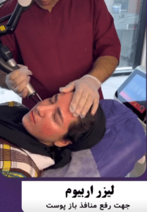 نمونه درمان جای لک و جوش دکتر قاسم رحمت پور رکنی (کلینیک زیبایی باران)