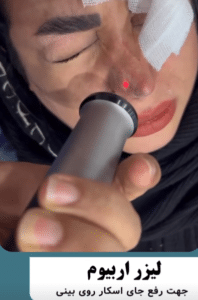 نمونه درمان جای لک و جوش دکتر قاسم رحمت پور رکنی (کلینیک زیبایی باران)