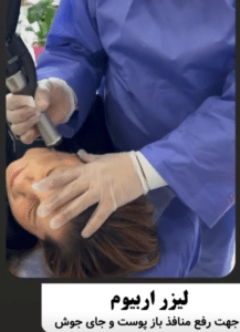 نمونه درمان جای لک و جوش دکتر قاسم رحمت پور رکنی (کلینیک زیبایی باران)