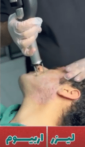 نمونه درمان جای لک و جوش دکتر قاسم رحمت پور رکنی (کلینیک زیبایی باران)