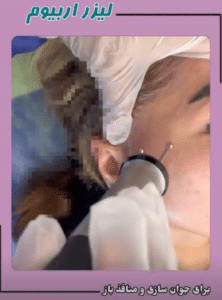 نمونه درمان جای لک و جوش دکتر قاسم رحمت پور رکنی (کلینیک زیبایی باران)