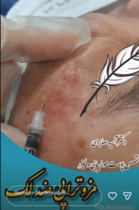 نمونه درمان جای لک و جوش دکتر آسیه صابری