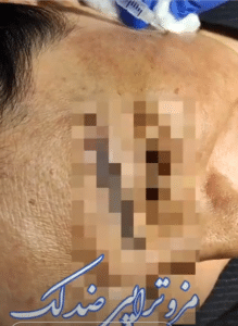 نمونه درمان جای لک و جوش دکتر آسیه صابری