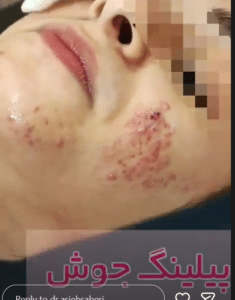 نمونه درمان جای لک و جوش دکتر آسیه صابری