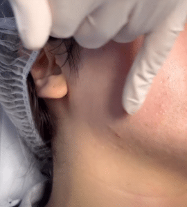 نمونه درمان جای لک و جوش دکتر حسین خسروی