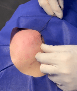 نمونه درمان جای لک و جوش دکتر حسین خسروی