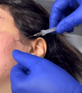 نمونه درمان جای لک و جوش دکتر حسین خسروی