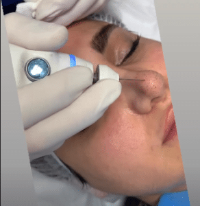 نمونه درمان جای لک و جوش دکتر حسین خسروی