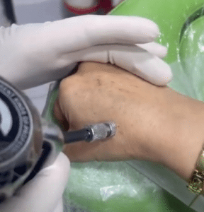 نمونه درمان جای لک و جوش دکتر علی خوش نظر