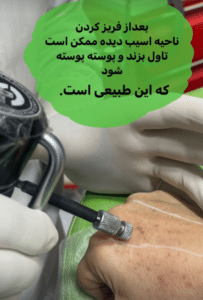 نمونه درمان جای لک و جوش دکتر علی خوش نظر