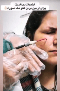 نمونه درمان جای لک و جوش دکتر علی خوش نظر