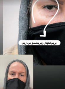 نمونه درمان جای لک و جوش دکتر علی خوش نظر