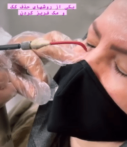 نمونه درمان جای لک و جوش دکتر علی خوش نظر