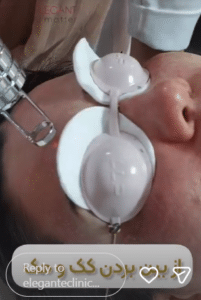 نمونه درمان لک و جوش کلینیک زیبایی الگانت