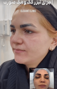 نمونه درمان لک و جوش کلینیک زیبایی الگانت