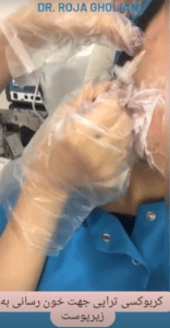 نمونه درمان جای لک و جوش دکتر رجا قلیان