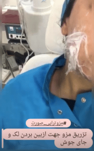 نمونه درمان جای لک و جوش دکتر رجا قلیان