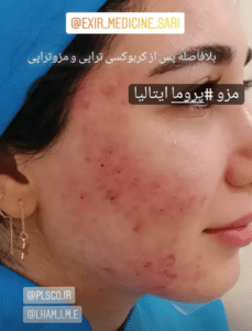 نمونه درمان جای لک و جوش دکتر رجا قلیان