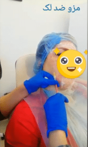 نمونه درمان جای لک و جوش دکتر رجا قلیان