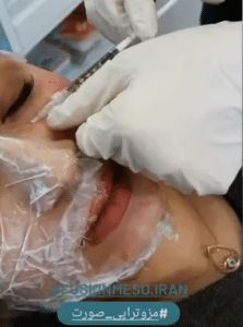 نمونه درمان جای لک و جوش دکتر رجا قلیان