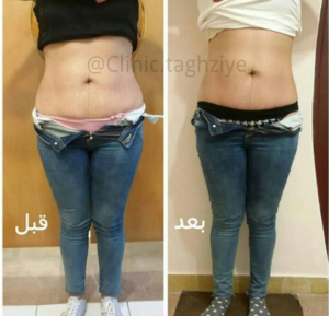 نمونه کاهش وزن با رژیم لاغری دکتر شیرین اباذری
