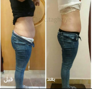 نمونه کاهش وزن با رژیم لاغری دکتر شیرین اباذری