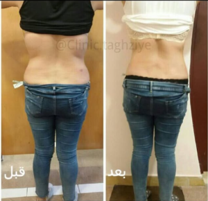 نمونه کاهش وزن با رژیم لاغری دکتر شیرین اباذری