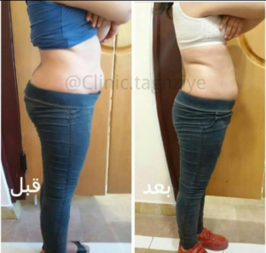 نمونه کاهش وزن با رژیم لاغری دکتر شیرین اباذری